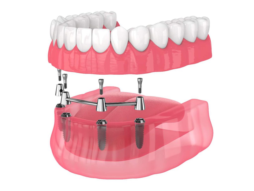 Bar retained removable overdenture installation supported by implants over white backgroud